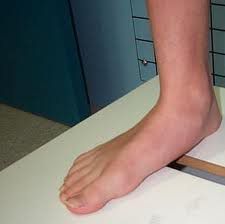 Flat foot Flat foot